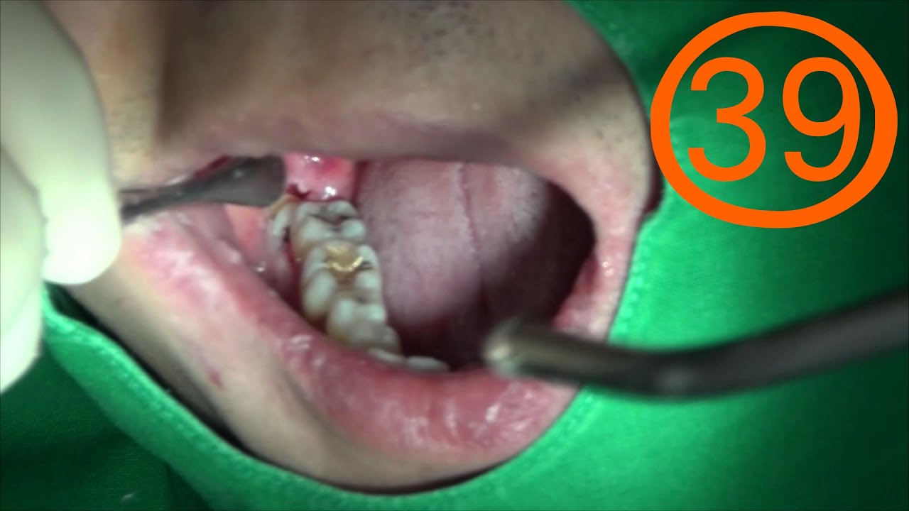 #48 Surgical Extraction Of Lower Horizontal Impacted Wisdom Teeth - YouTube