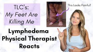 Lymphedema Physical Therapist Reacts: Severe Leg Lymphedema - My Feet are Killing Me