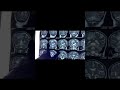 Neurosurgery OT Vlog #shorts