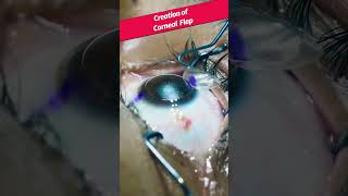 Cornea repair || 3D animation|| Advance eye treatment #anatomy #3danimation #eyes #cornea #laser