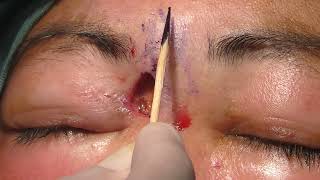 Instructional Video Series : Mole, Ulcerated ( Suspicious of Malignacy ) | Dr. Jim Sanchez