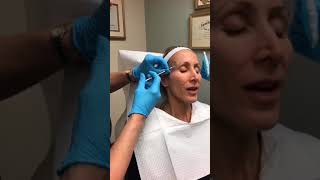 Juvederm Voluma XC in the Hollowed Temples