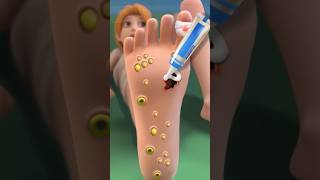 ASMR foot care remove big plantar worm & psoriasis 2d  animation treatment video