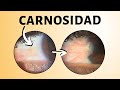 PINGUÉCULA 🔴 ¿Qué es y Cómo EVITAR que CREZCA una Carnosidad del Ojo?