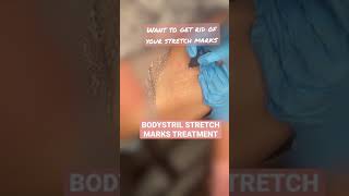 STRETCH MARK TREATMENT! Insta for more :) #shorts #stretchmarkremoval #stretchmarks #treatment