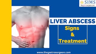 Best treatment for Liver Abscess |Liver abscess signs and treatment | Liver abscess |