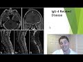 multiple sclerosis differential diagnosis