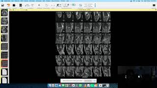 MRI PILONIDAL SINUS