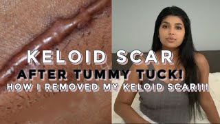 MY TUMMY TUCK KELOID SCAR & How I had it removed!