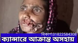 গোলছারা বেগম ওরাল ক্যান্সারে আক্রান্ত একজন মুমূর্ষু রোগী। অসহায় গৃহহীন স্বামীহারা এক নারী,