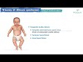 down syndrome trisomy 21 genetics clinical manifestations diagnosis image disscussion