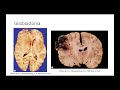 tumors of the central nervous system