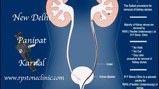 Animation of Kidney stone treatment by RIRS  Flexible Ureteroscopy