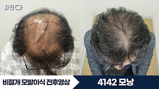 4142모낭 대량이식 정수리 M자 #자라다의원