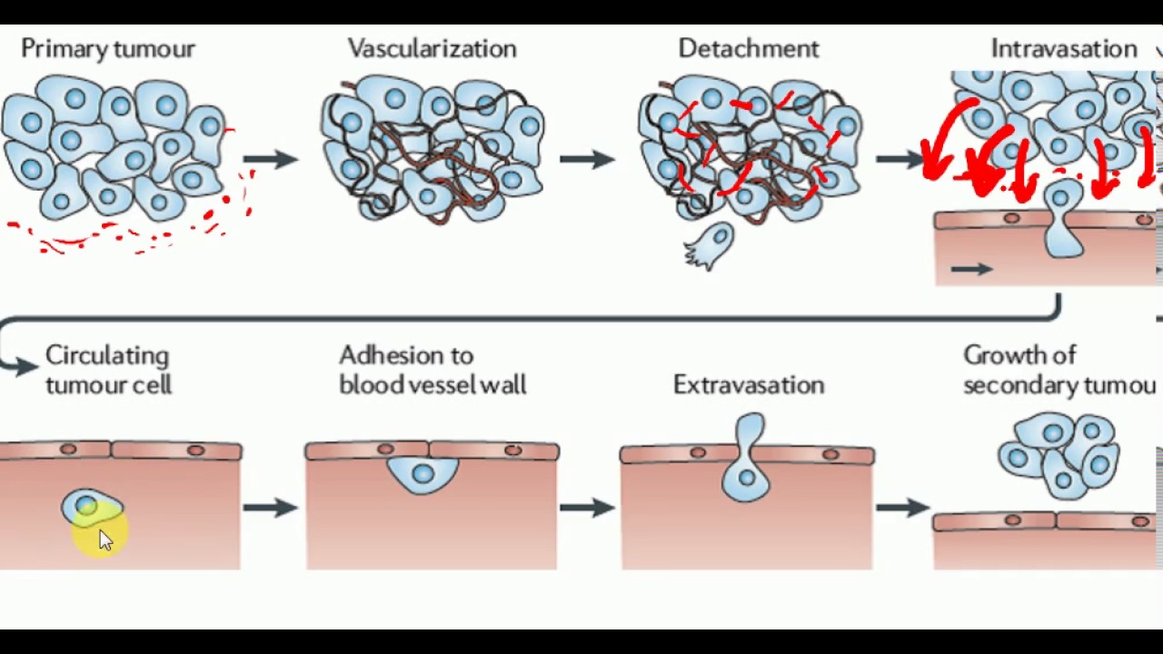 Pathology Lectures Neoplasia Part 2 Youtube