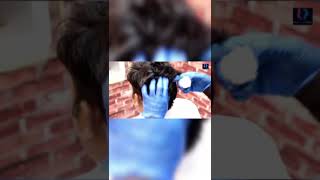 Hair Patch Service for Men | Permanent Hair Patch | #shorts