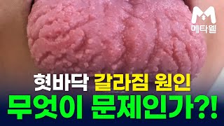 혓바닥 갈라짐 원인 무엇이 문제인가?! 100세까지 도움되는 메타웰 건강정보 건강꿀팁 #시니어 #혀갈라짐