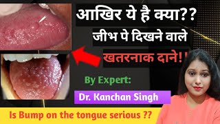 जीभ के नीचे दाना होना / Bump on tongue/ swollen bump on tongue/ Dr. Kanchan Singh