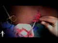 left upper extremity brachiobasilic arteriovenous fistula creation rahimi md chauhan md