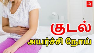 குடல் அயர்ச்சி நோய் | Irritable bowel syndrome | IBS | Aathichoodi