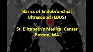 EBUS Basics and Mediastinal Staging -- BAVLS