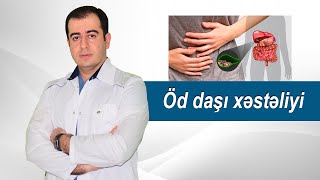 Öd daşı xəstəliyi