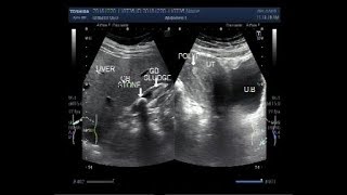 Ultrasound Video showing the difference between the Stone and Sludge in Gall Bladder.