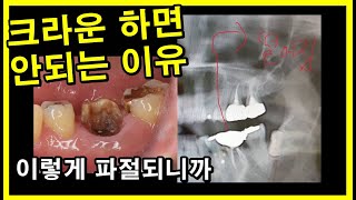 크라운 하면 안되는 이유. 파절이 일어나니까... 크라운같은 인공치아를 하면 파절, 잇몸병으로 치아를 빨리 파괴해 임플란트하게됨.  33세에 임플란트라니. 2021_09_02