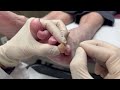 *super satisfying* triple deep corn removal u0026 thick nail cutting dr. kim kim foot and ankle