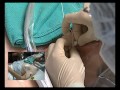 upper limb blocks interscalene catheter placement