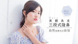 Dora 自然翹鼻找回自信 異體真皮三段式隆鼻 台北亞緻 謝宇軒醫師