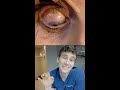 removing 23 contact lenses stuck in eye reaction