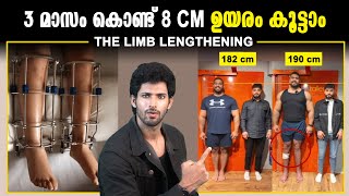 How to increase Height with Limb lengthening Surgery | Malayalam | Aadhil Unais Hussain