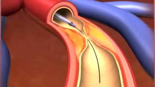 Percutaneous coronary Intervention stenting