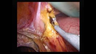 Hand assisted Lap  Lysis adhesion band with distal pancreatosplenectomy