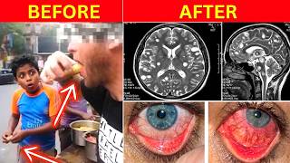 He Ate Indian Street Food. 1 Month Later, Worms Devoured His Brain.