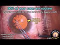 CataractCoach 1309: 90% of your cataract surgery cases are routine