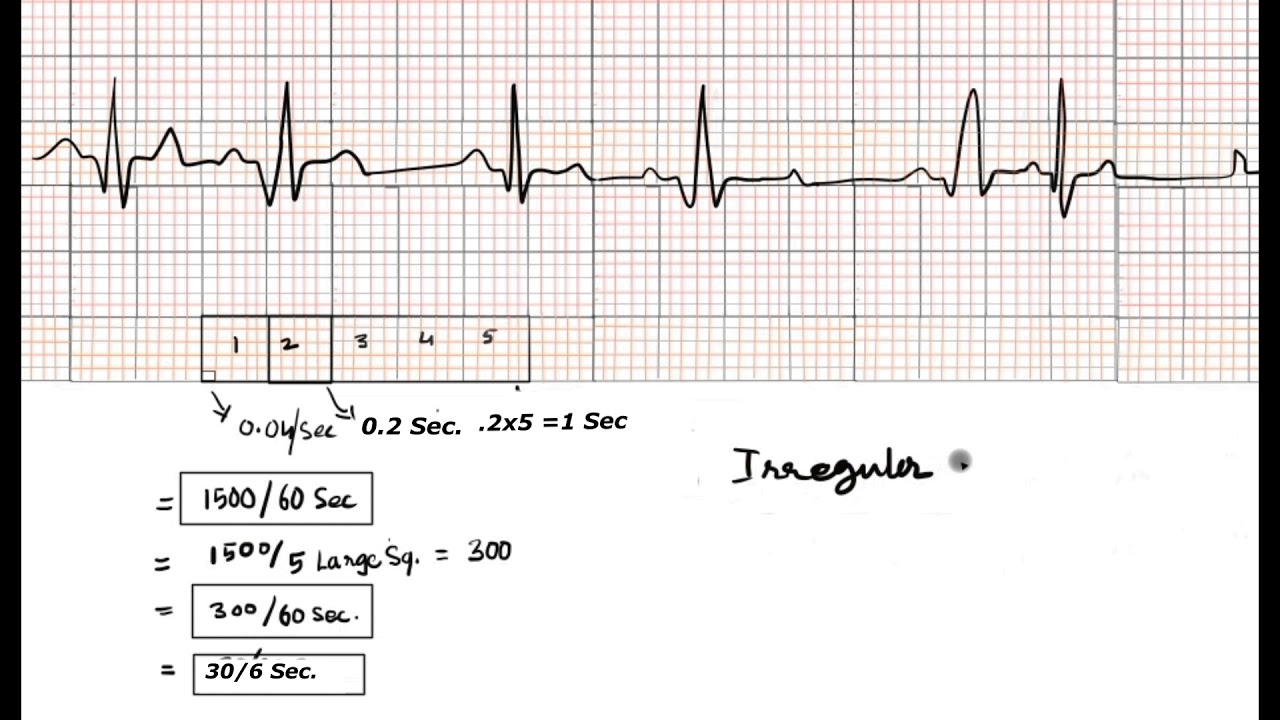 Calculation Of Heart Rate In Irregular Rhythm Store Www Jkuat Ac Ke