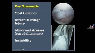 Wellness Webinar: Ankle Arthritis- From Rehab to Replacement