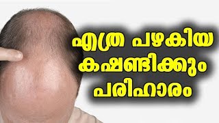 എത്ര പഴകിയ കഷണ്ടി ആയാലും പരിഹാരം | bald treatment