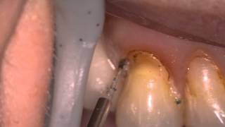 Gingivectomy using Zolar Dental Diode Laser : By Dr. Glen Van As.