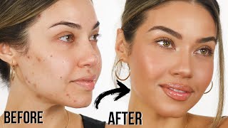 HOW TO GET RID OF ACNE (Actually Works!) | How To Get Clear Skin