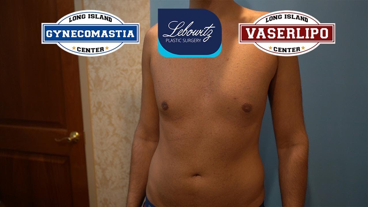 CALIFORNIA MALE 4D HI-DEF GYNECOMASTIA SURGERY - Dr. Lebowitz, Long ...