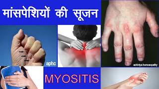 मायोसिटिस का अर्थ है मांसपेशियों की सूजन (MYOSITIS)