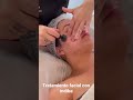 tratamiento de rejuvenecimiento facial con indiba