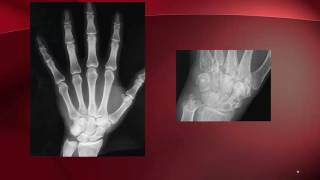 Understanding the Differences Between Rheumatoid Arthritis and Osteoarthritis