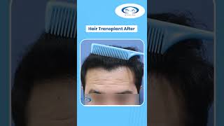💥Amazing Hair Transplant Result by Dr. A’s Clinic | #shorts #shortsfeed