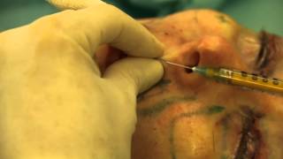 Sharp-Needle Intradermal Fat Grafting (SNIF)