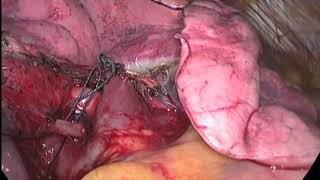 Asvide: Right middle lobe medial segmentectomy S4