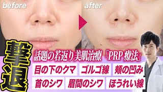 【若返り美肌治療】PRP(多血小板血漿)療法とはどんな治療？【クマ・ほうれい線・シワ】